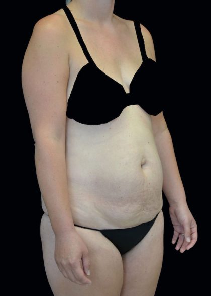 Lipoabdominoplasty Before & After Patient #17546