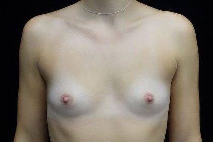 Breast Augmentation (Implants) Before & After Patient #17560