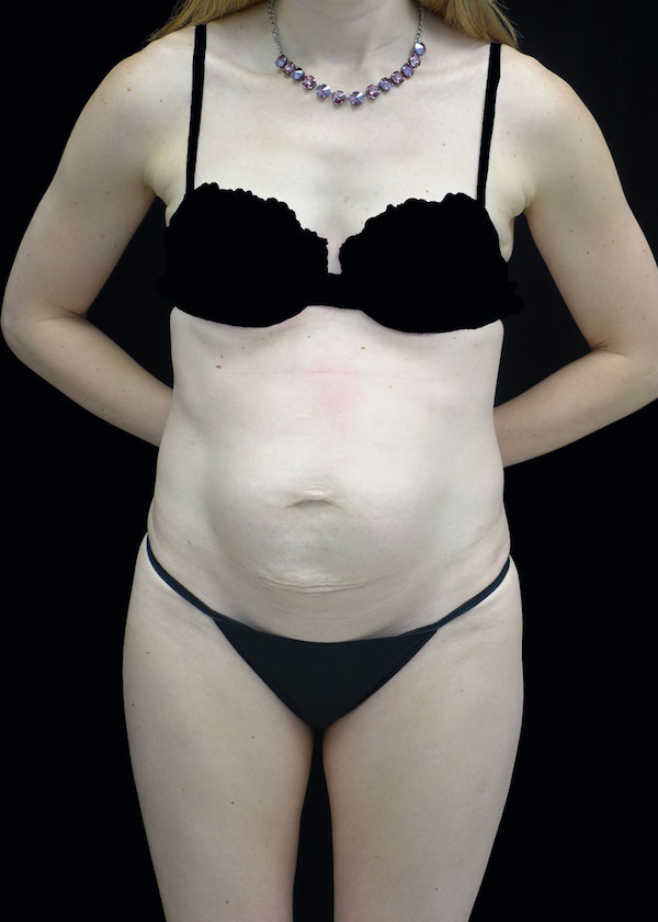 Tummy Tuck Before & After Patient #17577