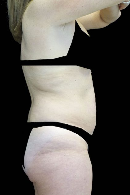 Lipoabdominoplasty Before & After Patient #17553