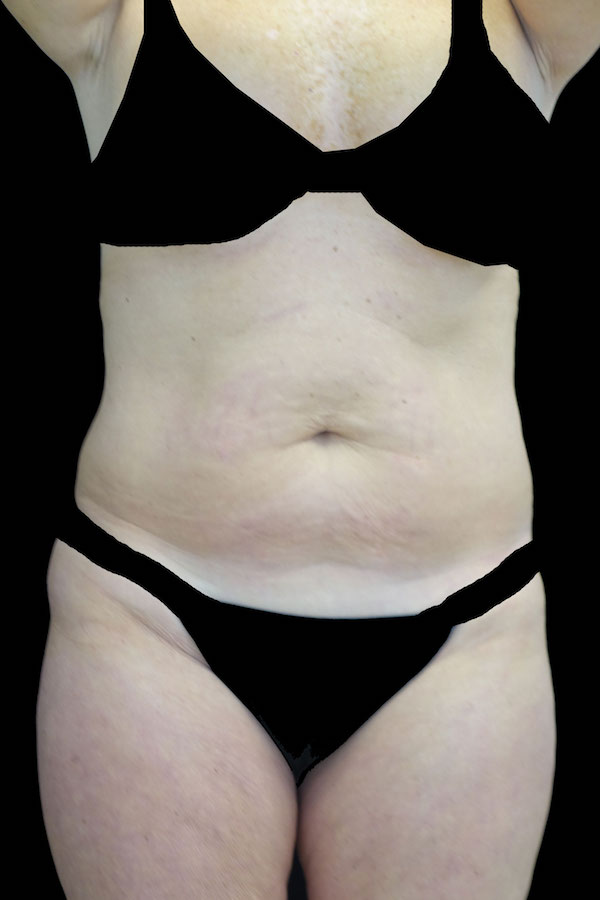 Lipoabdominoplasty Before & After Patient #17553