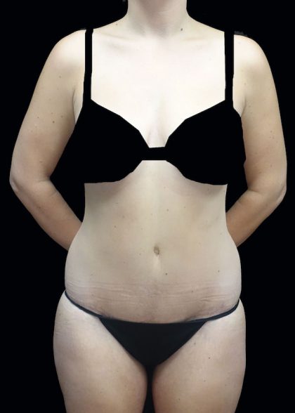 Lipoabdominoplasty Before & After Patient #17546