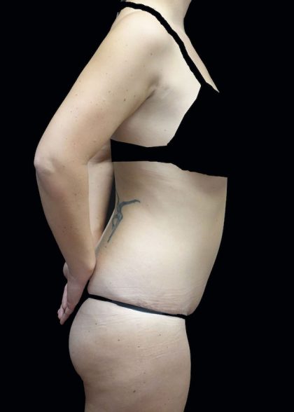 Lipoabdominoplasty Before & After Patient #17546