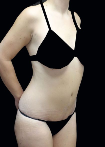 Lipoabdominoplasty Before & After Patient #17546