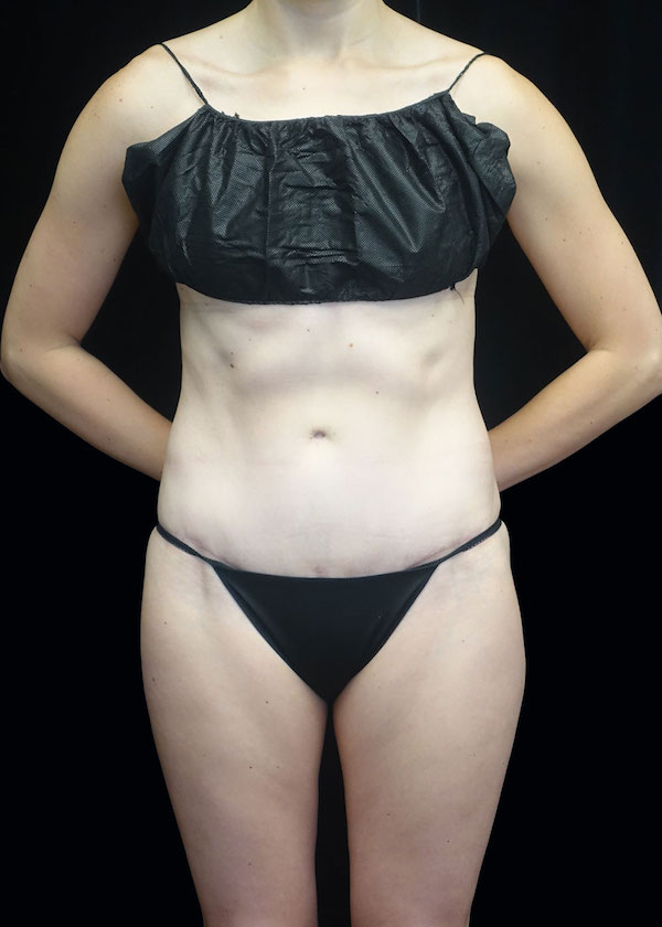 Tummy Tuck Before & After Patient #17577