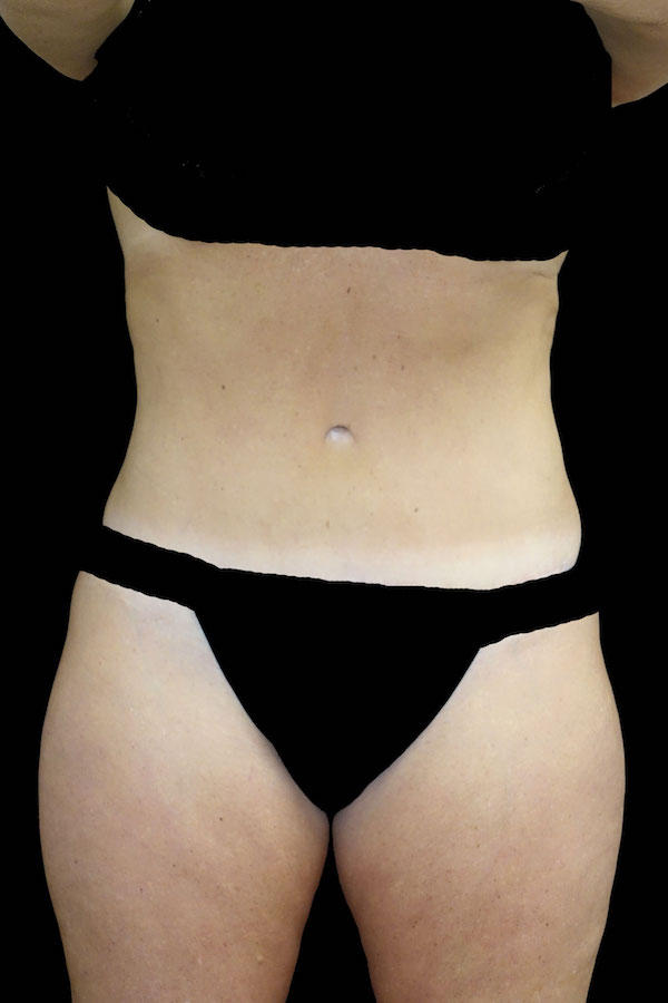 Lipoabdominoplasty Before & After Patient #17553