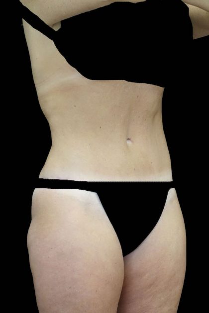 Lipoabdominoplasty Before & After Patient #17553