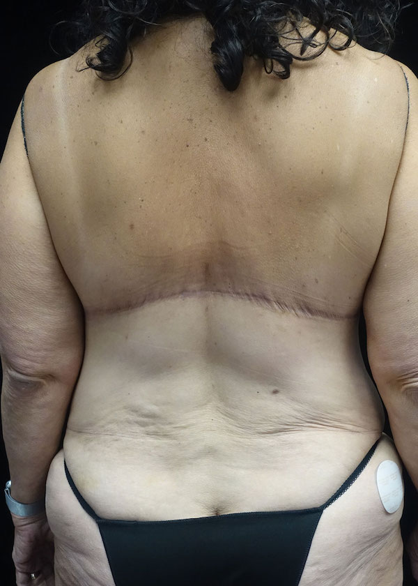 Bra Line Lift Before & After Patient #17574
