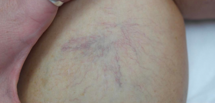 Leg Vein Treatment with Laser Before & After Patient #17649