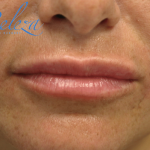 Lip Augmentation - Fillers Before & After Patient #17652
