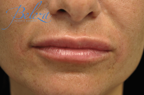 Lip Augmentation - Fillers Before & After Patient #17652