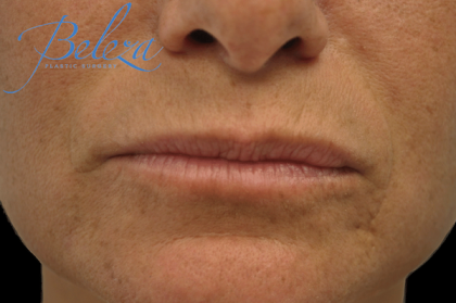 Lip Augmentation - Fillers Before & After Patient #17652