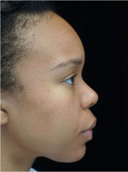Restylane Before & After Patient #17646