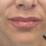 Lip Augmentation - Fillers Before & After Patient #17742