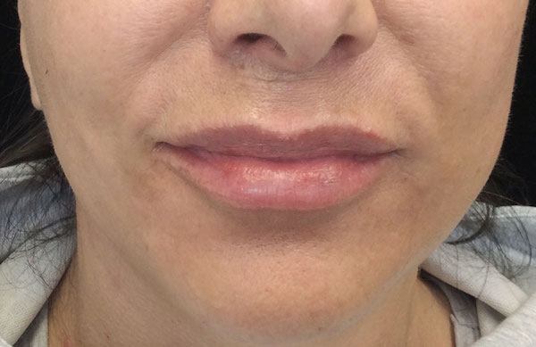 Lip Augmentation - Fillers Before & After Patient #17742