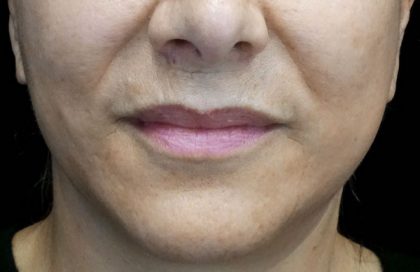 Lip Augmentation - Fillers Before & After Patient #17742