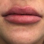 Lip Augmentation - Fillers Before & After Patient #17758