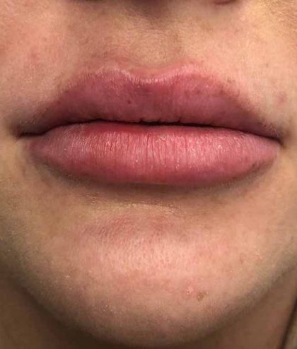 Lip Augmentation - Fillers Before & After Patient #17758