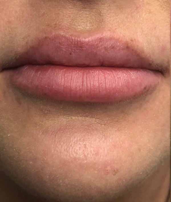 Lip Augmentation - Fillers Before & After Patient #17758