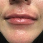 Lip Augmentation - Fillers Before & After Patient #17755