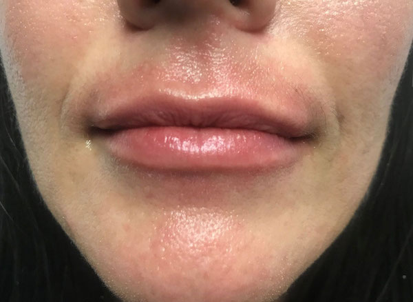 Lip Augmentation - Fillers Before & After Patient #17755