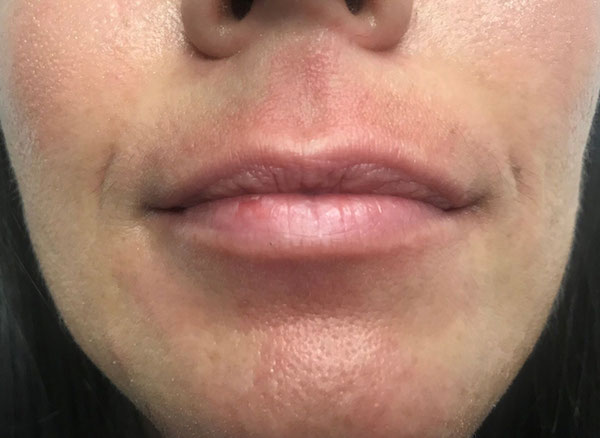Lip Augmentation - Fillers Before & After Patient #17755