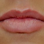 Lip Augmentation - Fillers Before & After Patient #17752