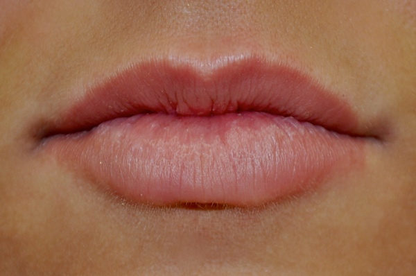 Lip Augmentation - Fillers Before & After Patient #17752