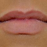 Lip Augmentation - Fillers Before & After Patient #17752