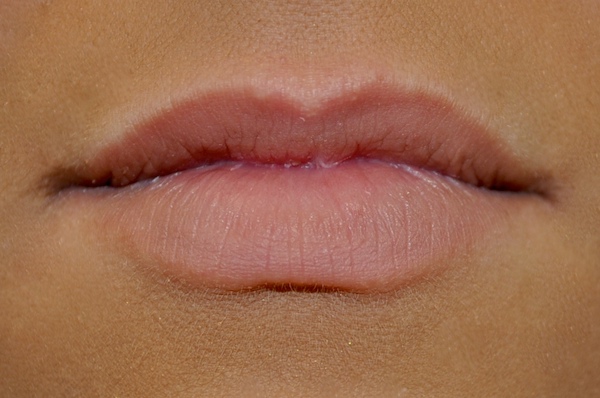 Lip Augmentation - Fillers Before & After Patient #17752