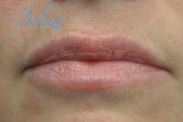 Lip Augmentation - Fillers Before & After Patient #17749