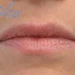 Lip Augmentation - Fillers Before & After Patient #17749