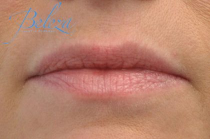 Lip Augmentation - Fillers Before & After Patient #17749