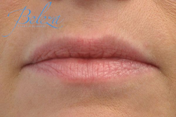 Lip Augmentation - Fillers Before & After Patient #17749