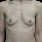 Breast Augmentation (Implants) Before & After Patient #17801