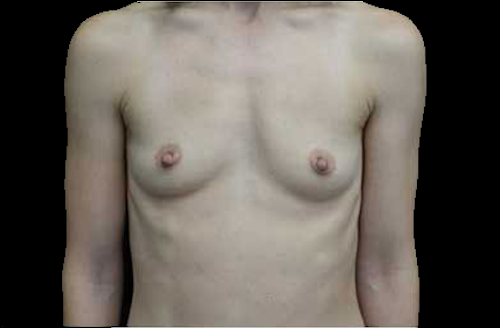 Breast Augmentation (Implants) Before & After Patient #17801