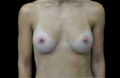 Breast Augmentation (Implants) Before & After Patient #17801
