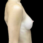 Breast Augmentation (Implants) Before & After Patient #17801