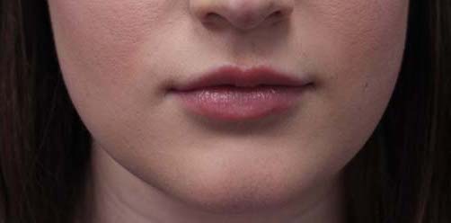 Lip Augmentation - Fillers Before & After Patient #17746
