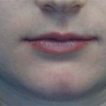 Lip Augmentation - Fillers Before & After Patient #17746