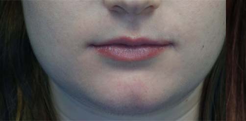 Lip Augmentation - Fillers Before & After Patient #17746