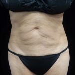 CoolSculpting Before & After Patient #17938