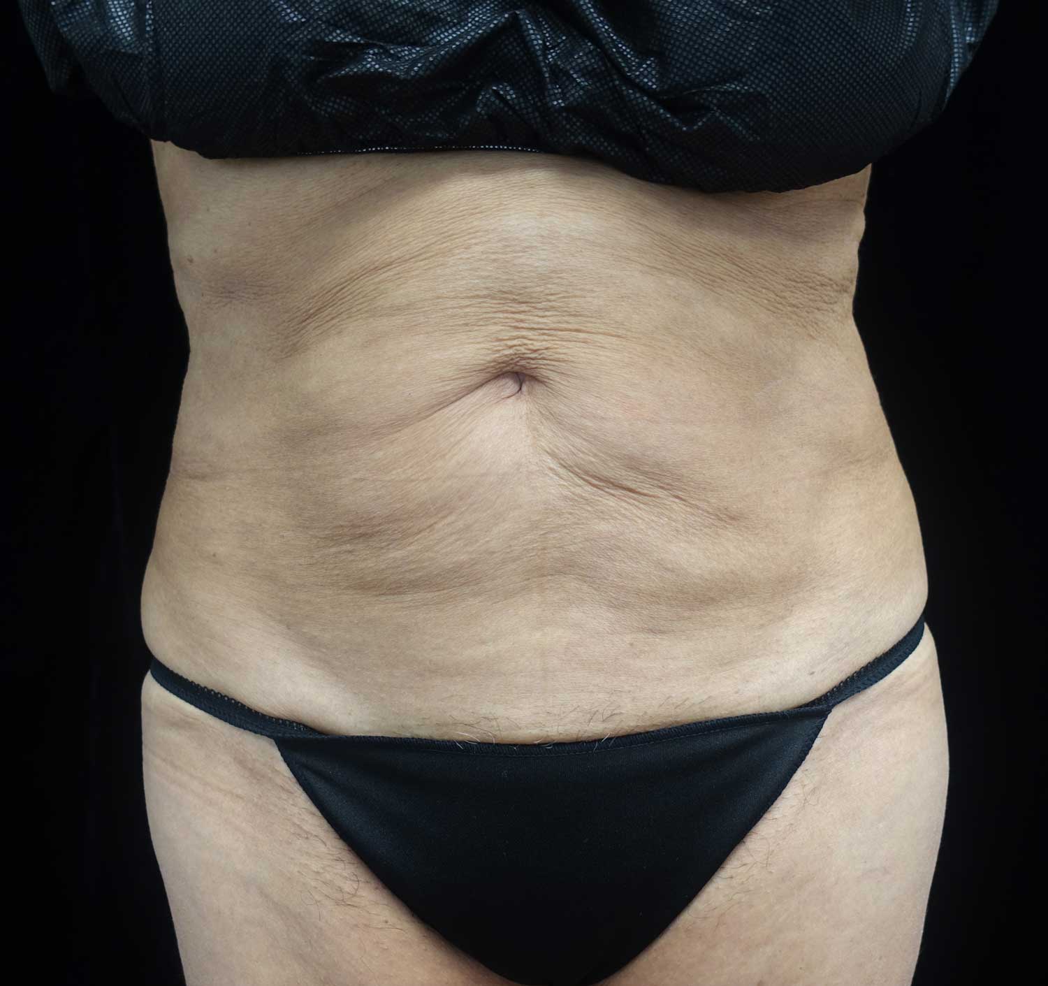CoolSculpting Before & After Patient #17938