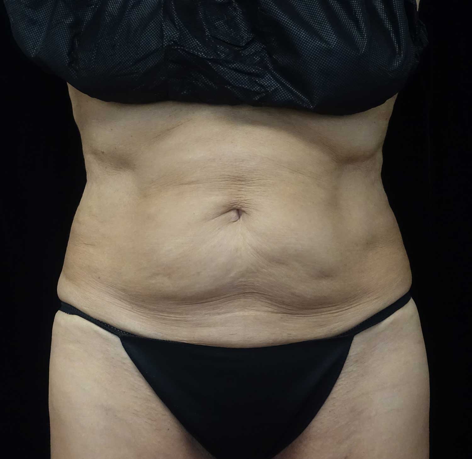 CoolSculpting Before & After Patient #17938