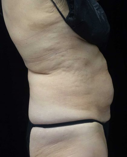 CoolSculpting Before & After Patient #17938
