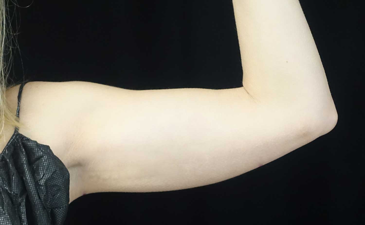 CoolSculpting Before & After Patient #17926