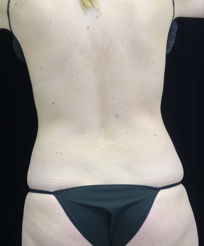 CoolSculpting Before & After Patient #17919