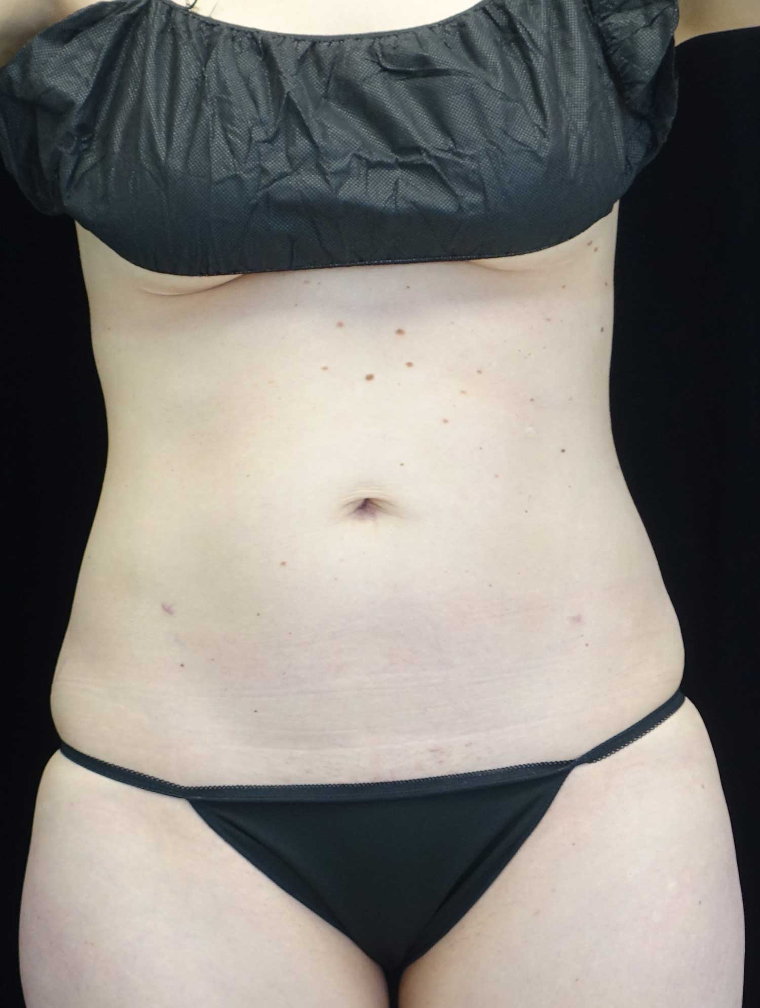CoolSculpting Before & After Patient #17919
