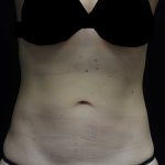 CoolSculpting Before & After Patient #17919