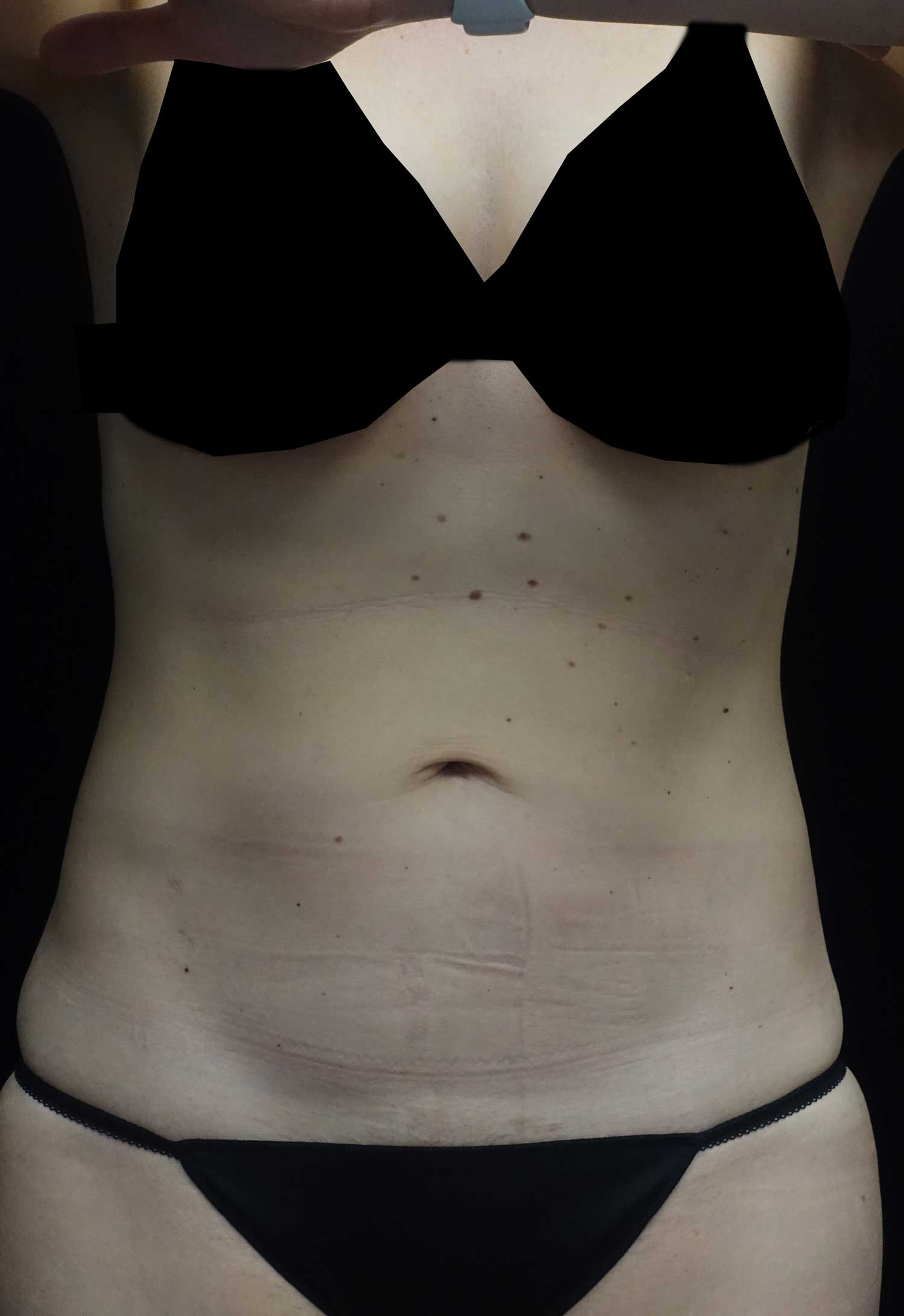 CoolSculpting Before & After Patient #17919
